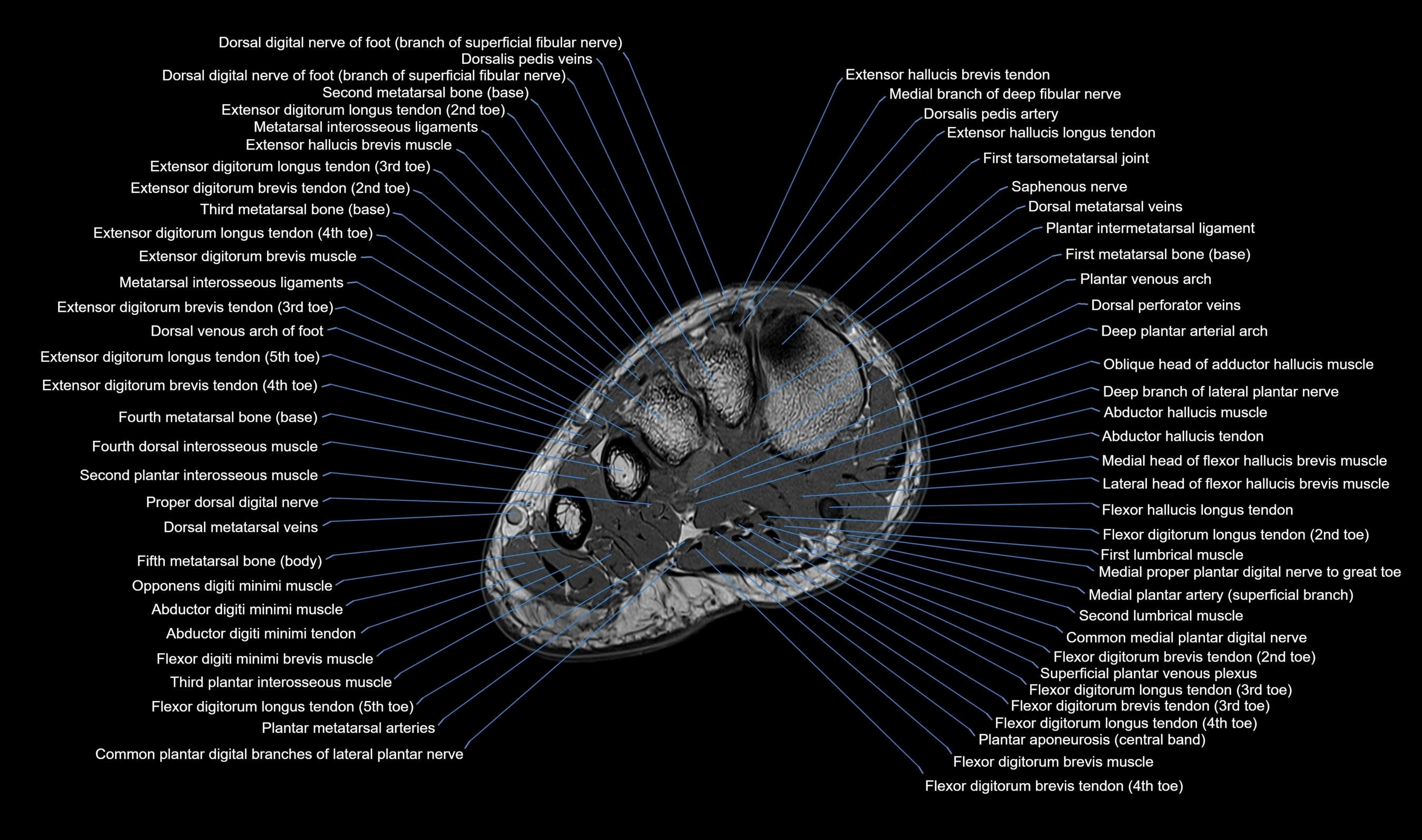 MRI mid foot axial cross sectional anatomy 3T  radiology  image-img-00001-00011.webp